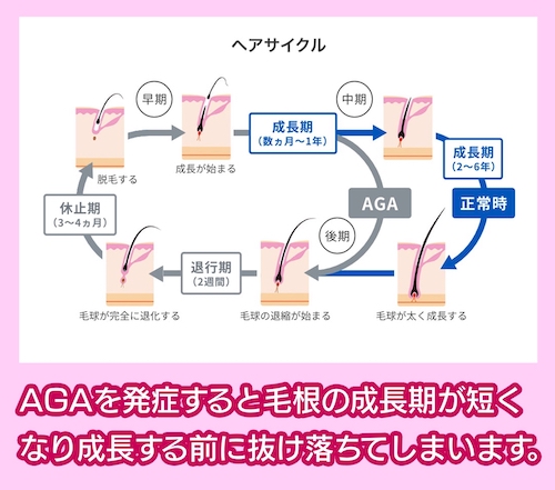 AGAのメカニズム