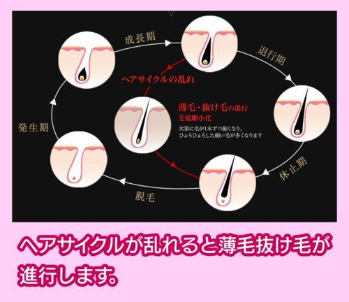 AGA(男性型脱毛症)