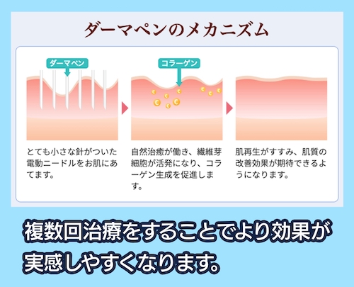 ダーマペンのメカニズム
