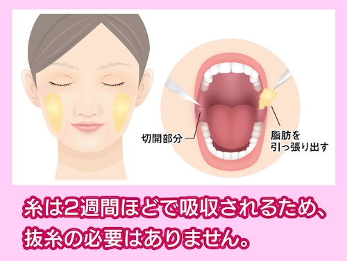 バッカルファット除去方法