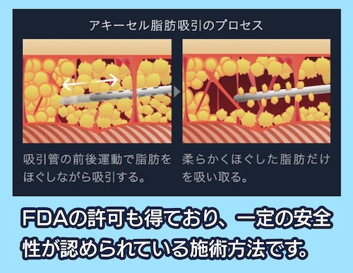theclinic アキーセル脂肪吸引