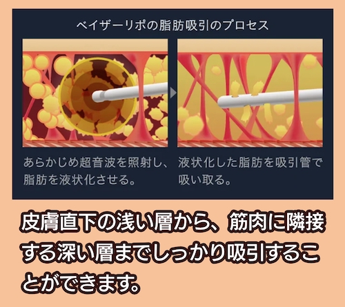 theclinic ベイザー脂肪吸引