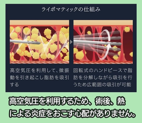 theclinic ライポマティック脂肪吸引