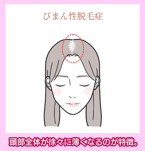 びまん性脱毛症