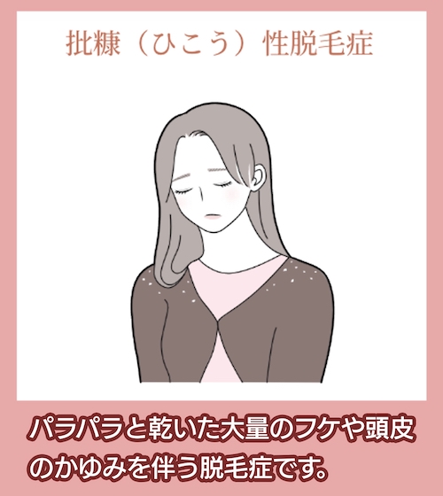 批糠(ひこう)性脱毛症