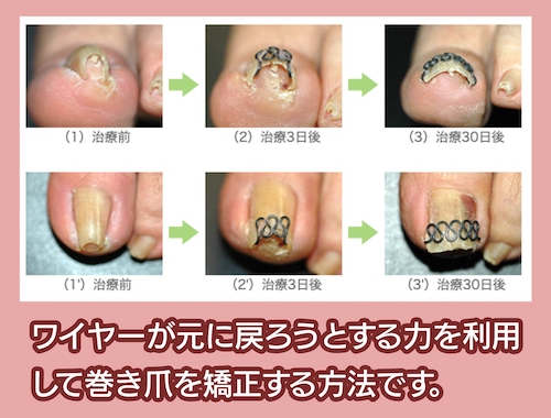 大山皮膚科 巻き爪の矯正治療