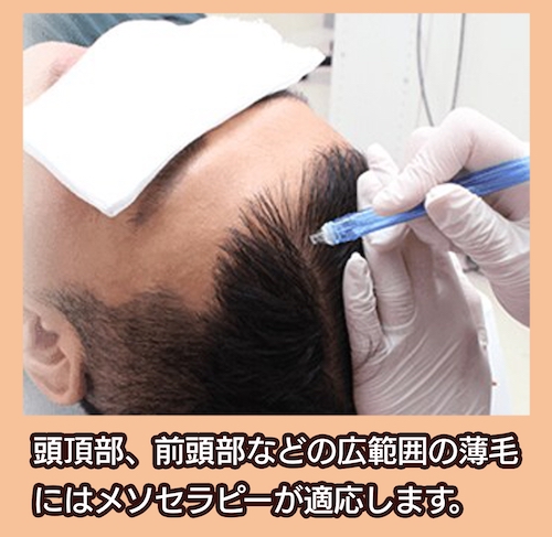 育毛メソセラピー 湘南美容クリニックMEN’S