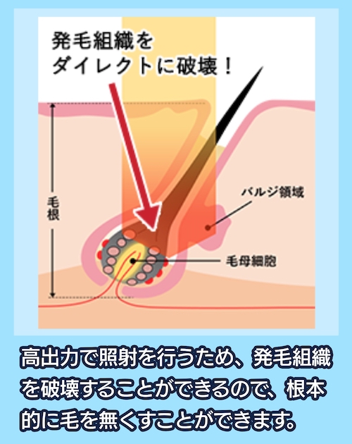 湘南美容クリニック ヒゲの医療脱毛の効果