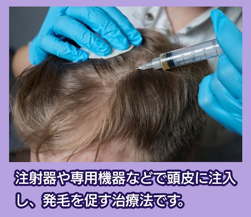 ウィルAGAクリニック 育毛メソセラピー