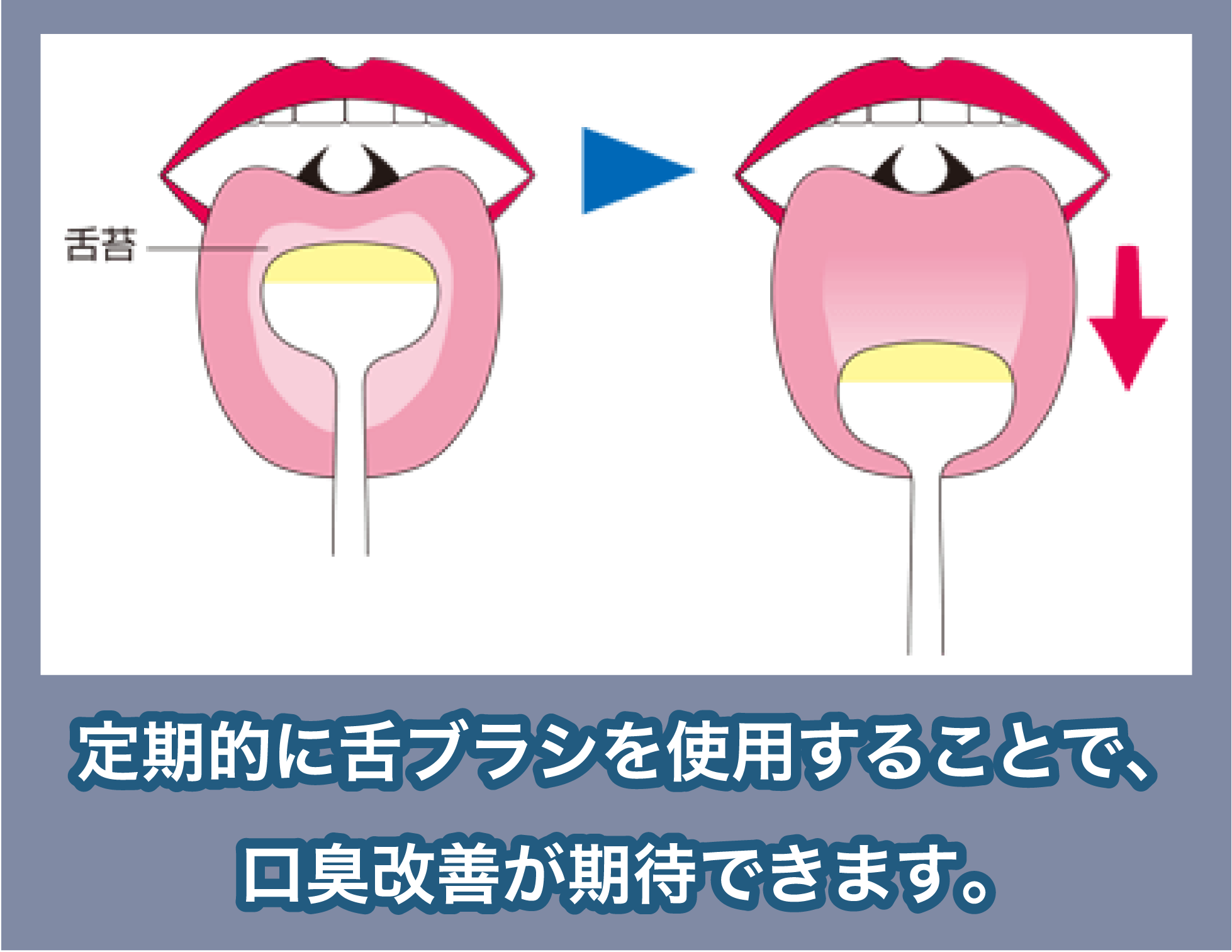 舌ブラシの効果