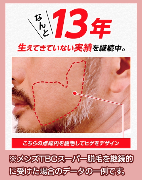 MEN’S TBC ヒゲ脱毛